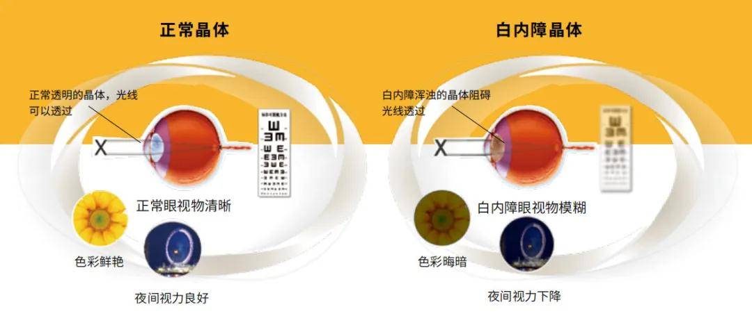 玻璃體混濁最新特效藥，突破與創新的治療策略